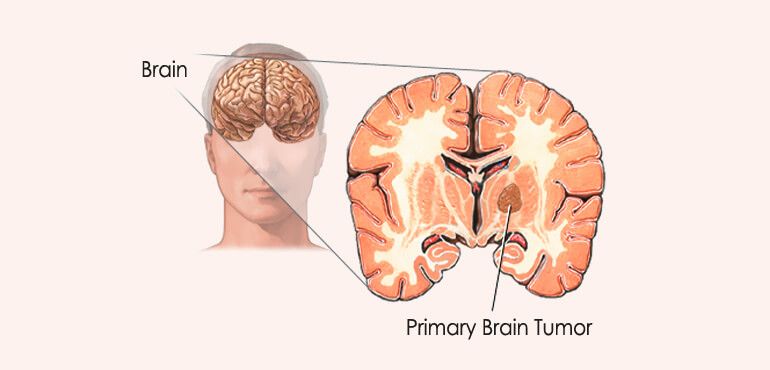 Human Brain Diseases List